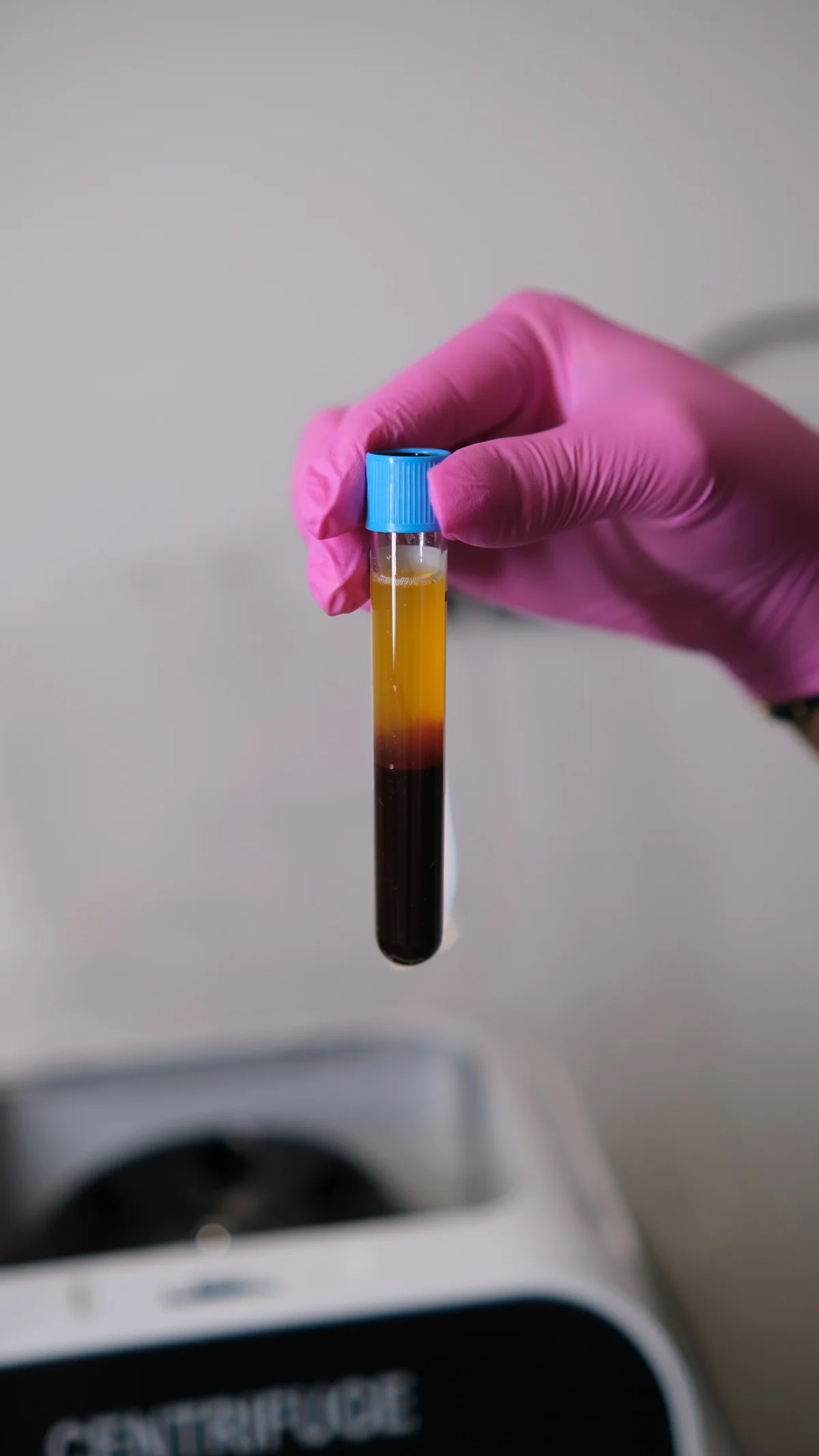 Platelet-rich fibrin (PRF) skin injection for natural wellness at a Houston aesthetic spa.