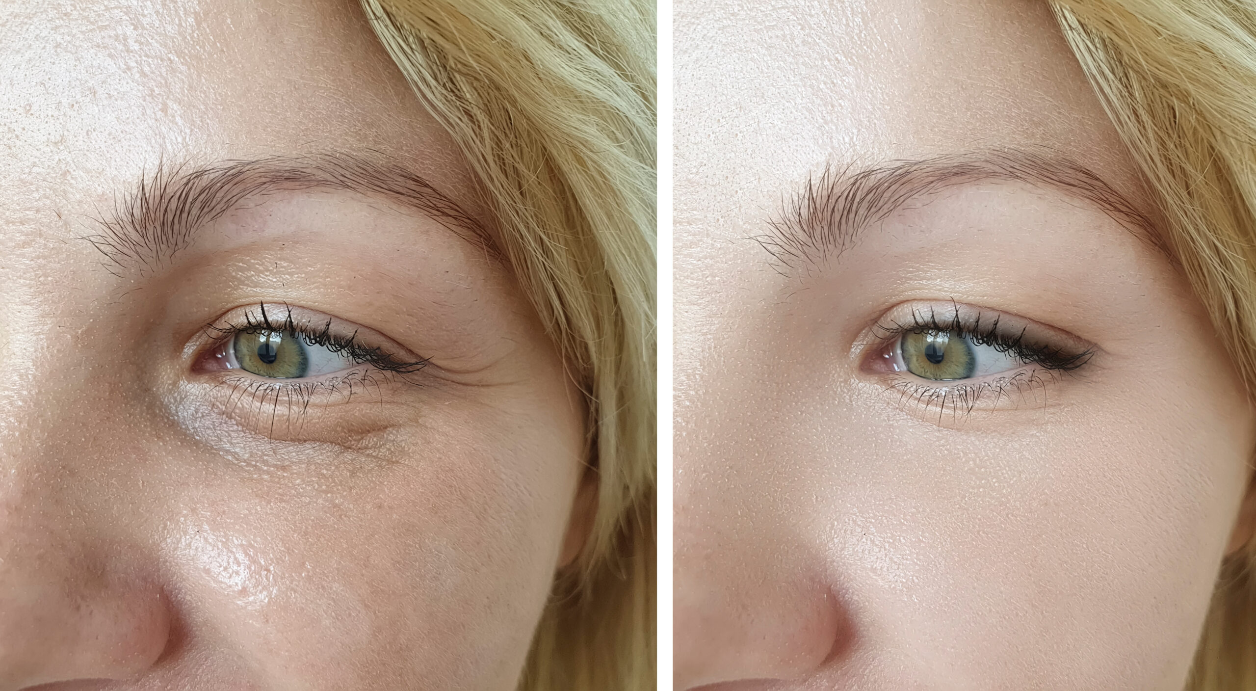 What to Expect During Your First Microinfusion Treatment | The Natural Aesthetic & Wellness in Houston, TX